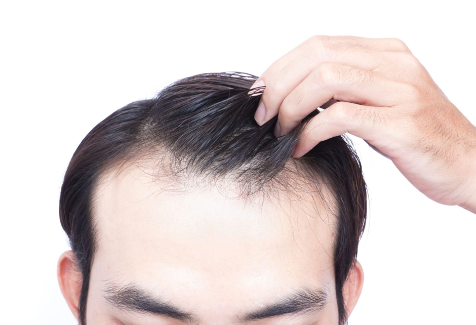 After FUE Hair Transplant