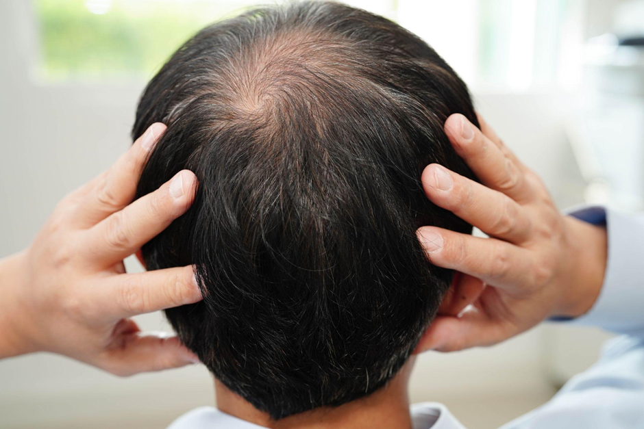 Understand about hair transplant