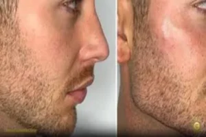 Jawline Filler: Comprehensive on Application and Benefits