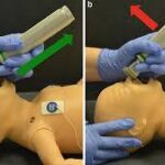 Different Methods Adopted by Medical Experts to Manage Neonatal Airway Care