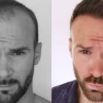 How Much Does Hair Transplant Cost In Turkey? Package And FUE Price Guide