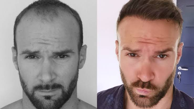 How Much Does Hair Transplant Cost In Turkey? Package And FUE Price Guide